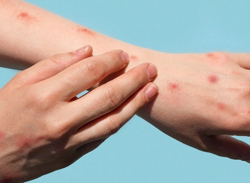 Bệnh đậu mùa khỉ ảnh 1 Benh dau mua khi anh 1