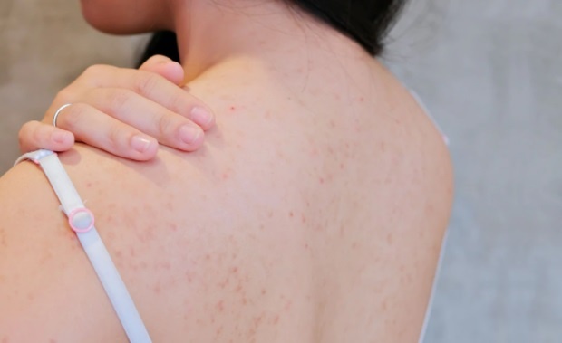 trị mụn ở lưng ảnh 1 tri mun o lung anh 1