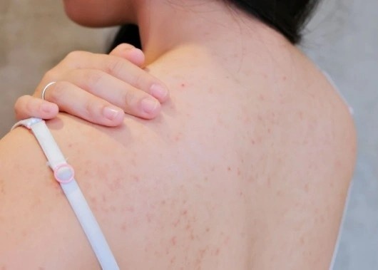 Ngo doc thuoc gay te, suyt tu vong vi tri mun lung tai spa hinh anh