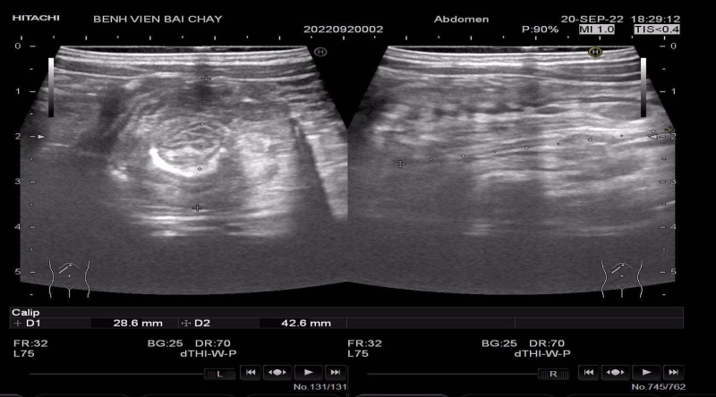 Benh long ruot anh 1