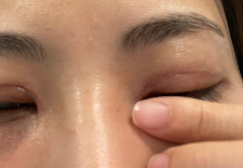 Phau thuat cat mi anh 1