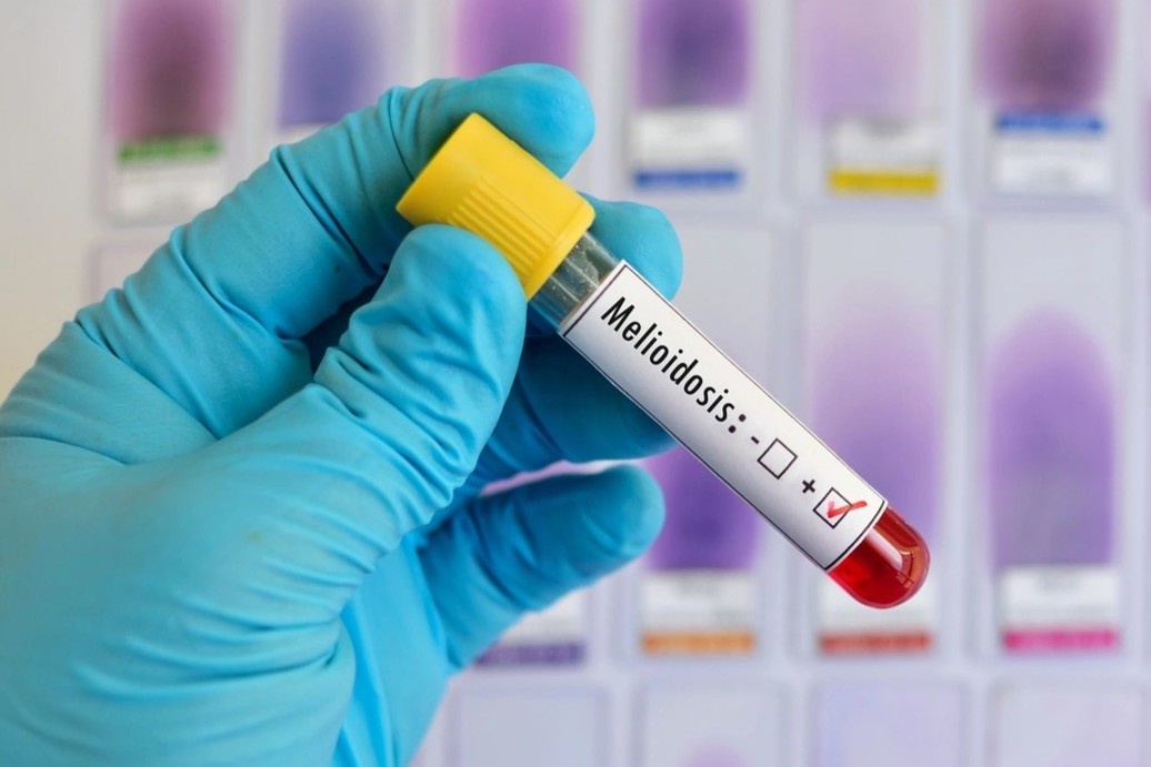 Benh nhi 15 tuoi tu vong vi Whitmore hinh anh