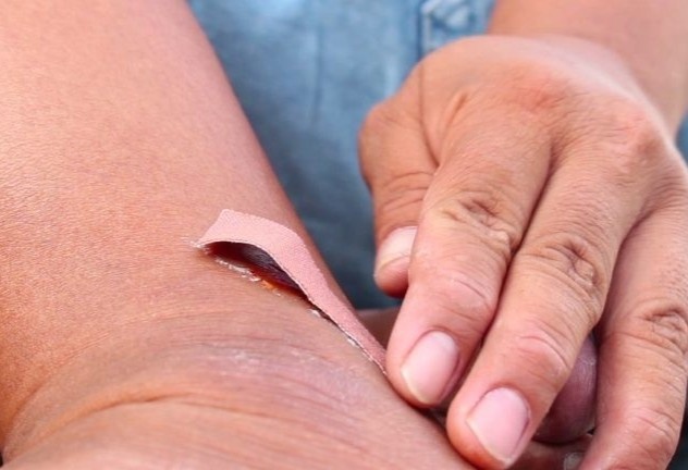 Cach xu ly vet thuong co nguy co nhiem vi trung uon van hinh anh