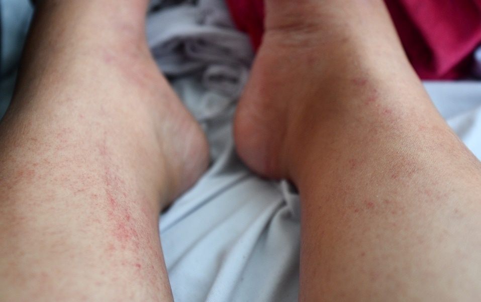 Hai nguoi dan ong tre tuoi o Ha Noi tu vong vi sot xuat huyet hinh anh