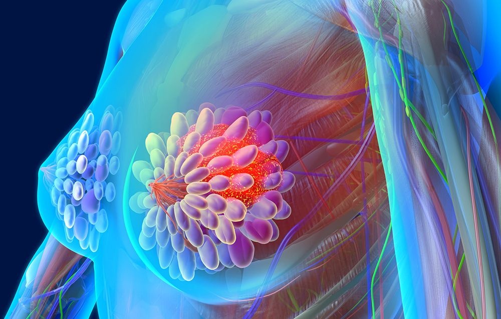 dau hieu ung thu vu anh 2