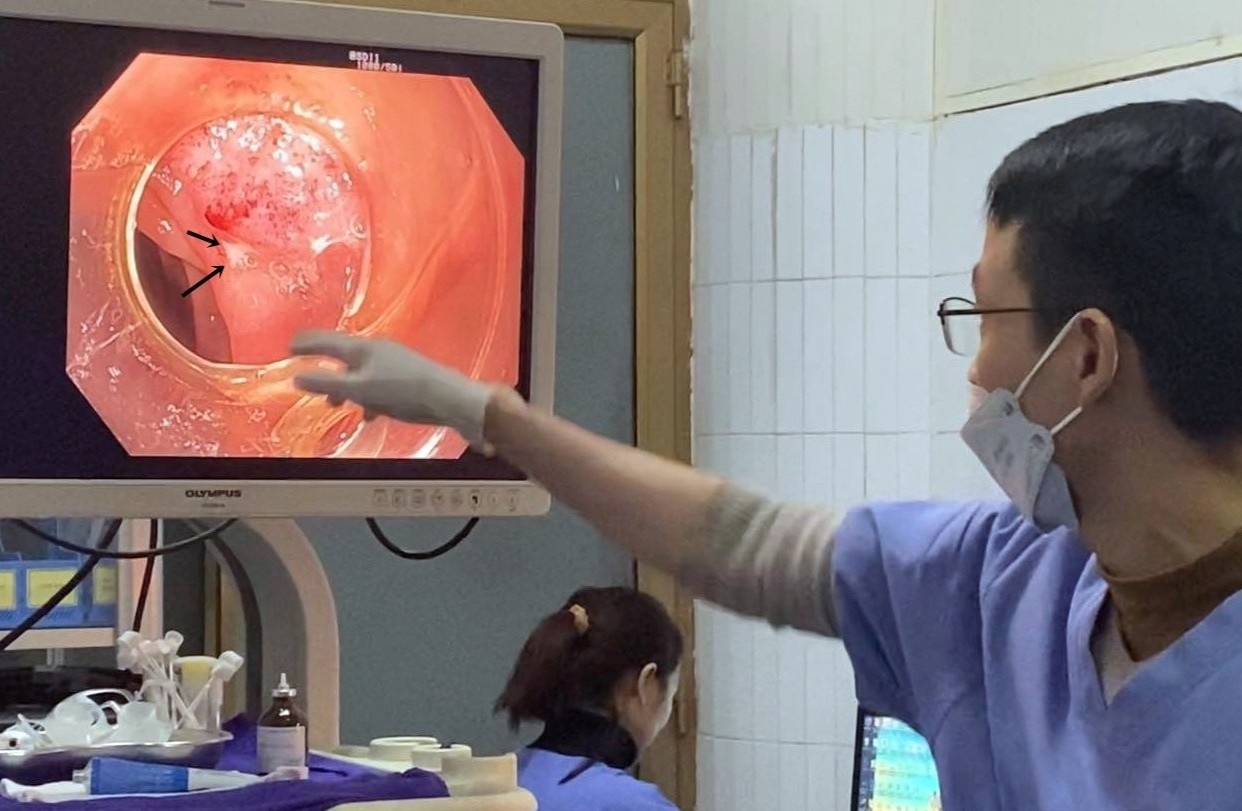 Thung ruot vi nuot nham tam hinh anh