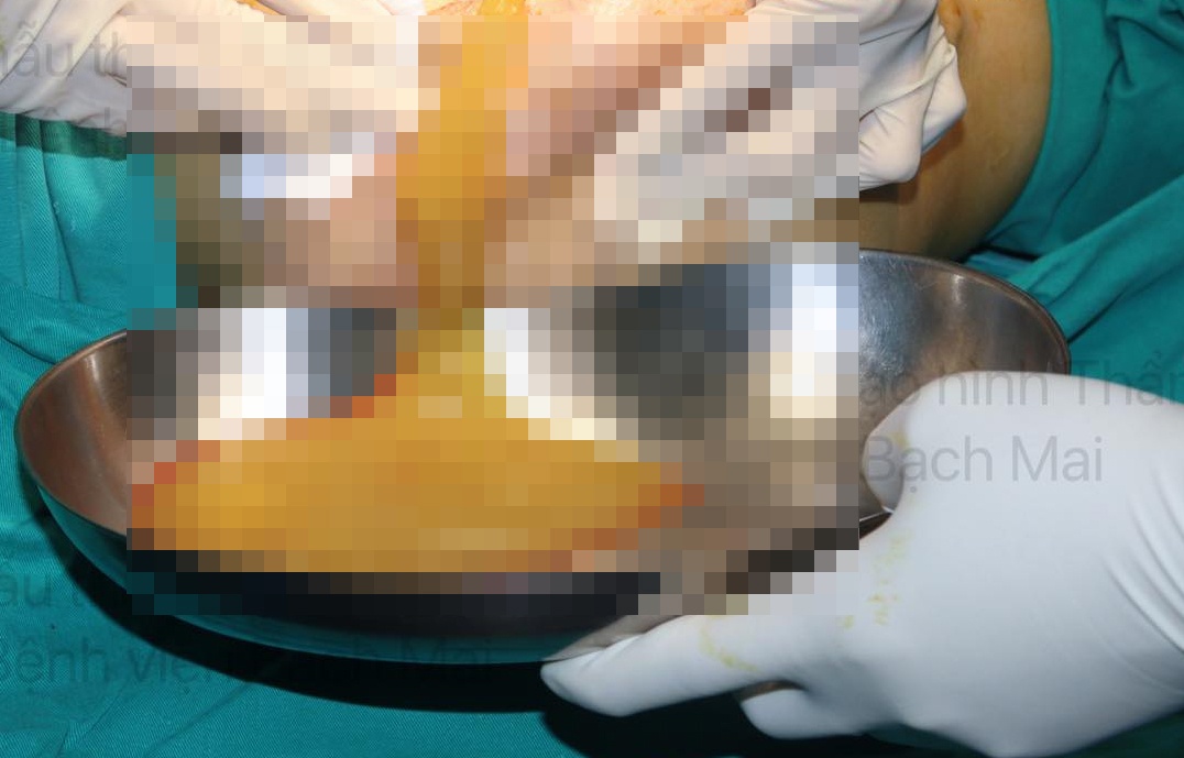 bien chung tiem filler anh 1