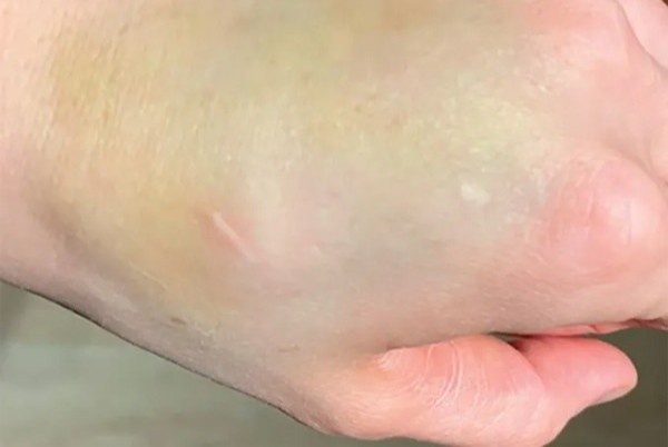 Vet bam tuong vo hai tren tay la dau hieu ung thu hinh anh