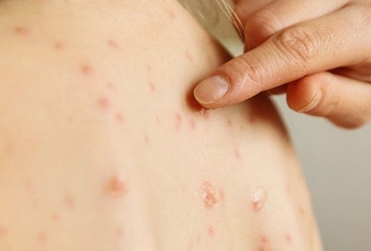 Benh thuy dau dien bien phuc tap tai Dak Lak hinh anh