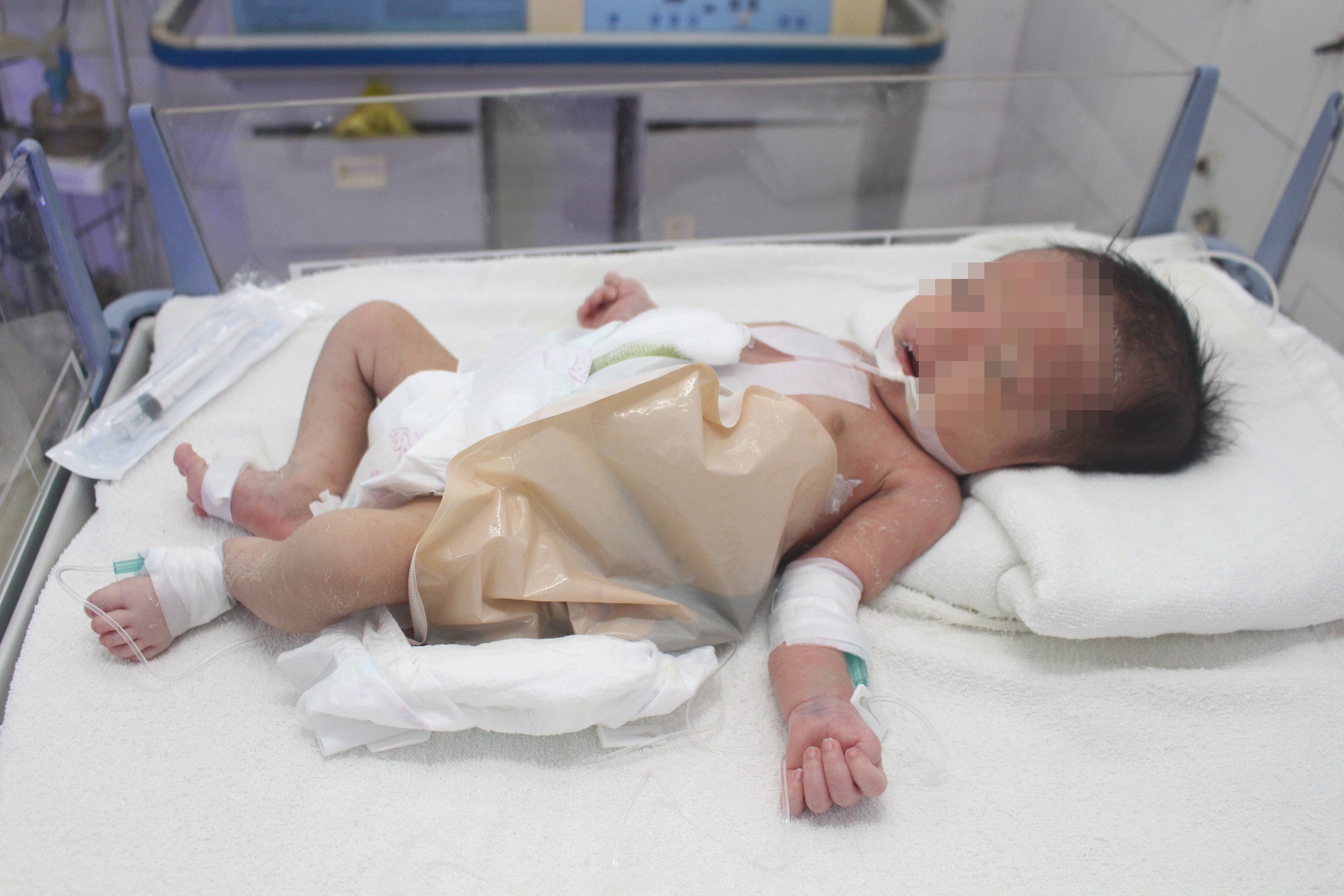 Bat ngo phat hien tre khong co hau mon vi mot tuan chua di tieu hinh anh