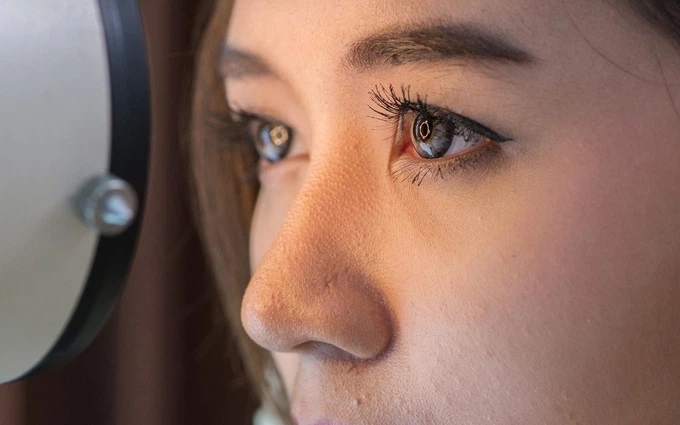 Moi va kho mat sau khi mo chua can thi hinh anh