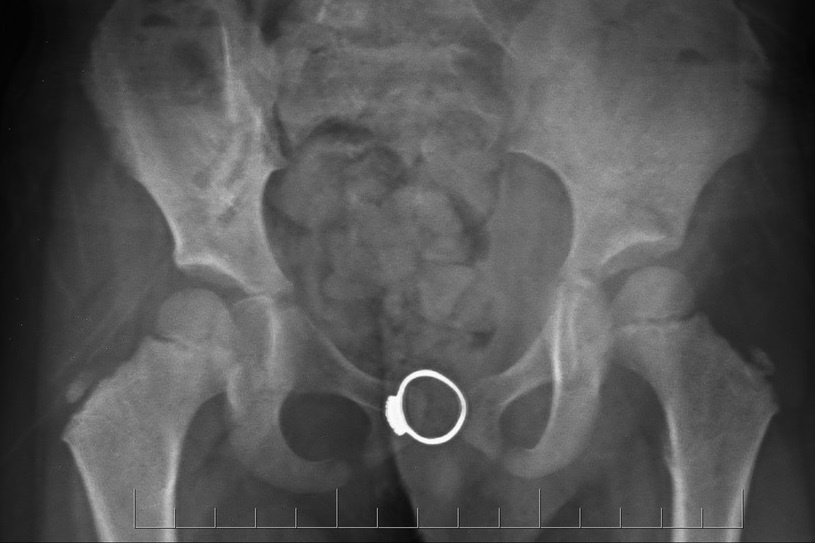 Thay nhan trong vung kin cua be gai 4 tuoi hinh anh