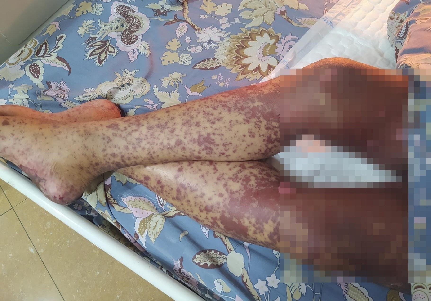 Nguoi dan ong bi hoai tu da toan than nghi do di ung thuoc hinh anh