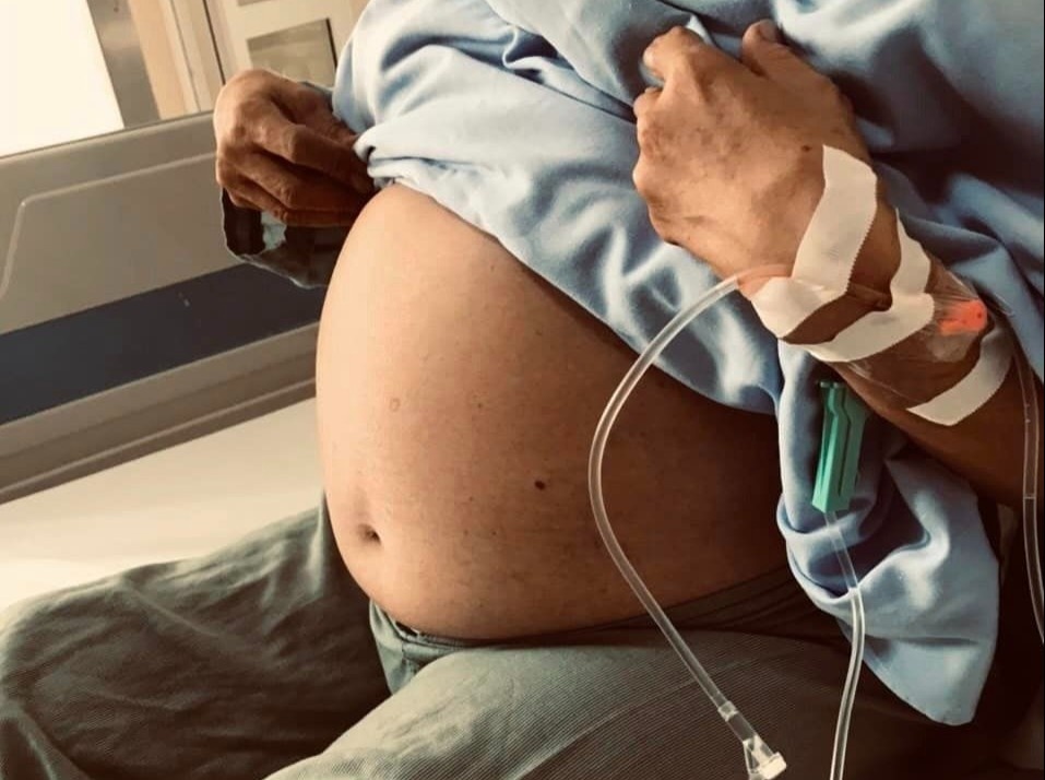 Mang khoi u gan 10 kg nhung lai tuong minh beo hinh anh