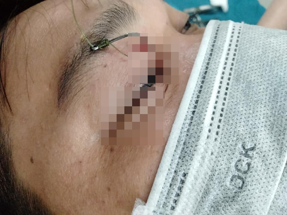 Nam thanh nien bi luoi cau cam vao mat hinh anh