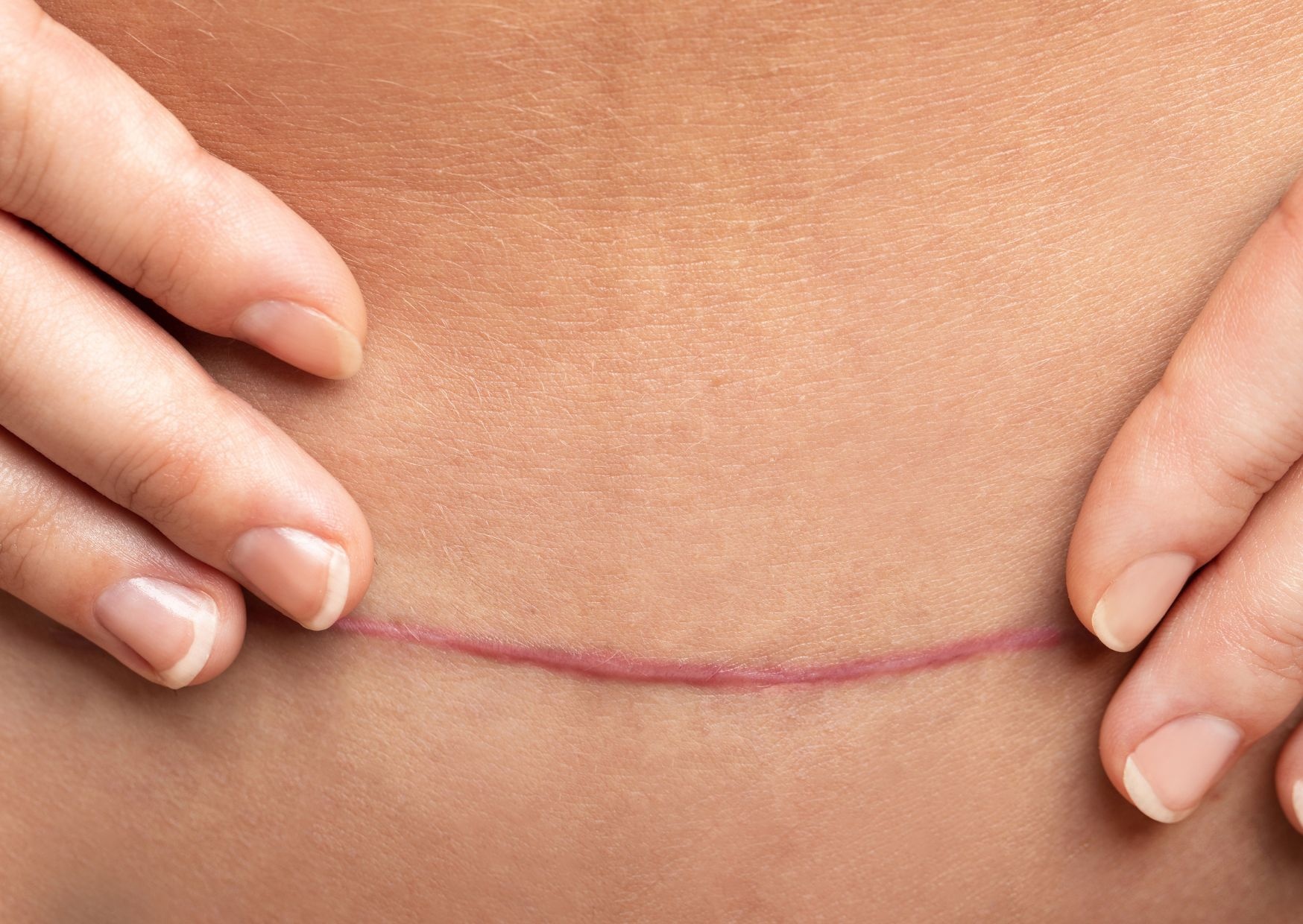 Nguoi phu nu 3 nam bi chay mau kinh tu vet seo mo de hinh anh