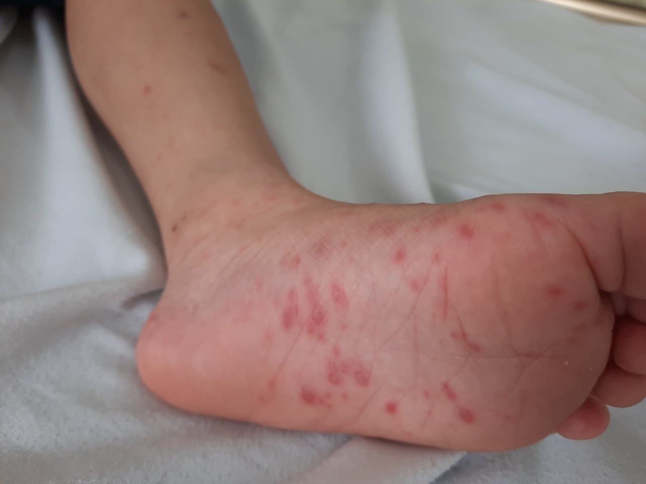 Nhieu tre Ha Noi nhap vien do mac benh tay chan mieng hinh anh