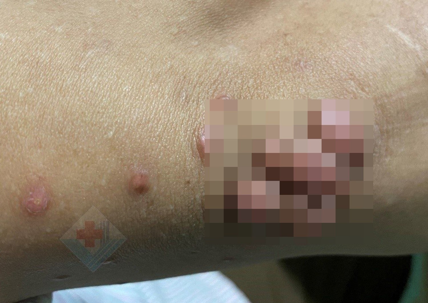 Nguoi dan ong moc nhieu khoi u tren co the hinh anh