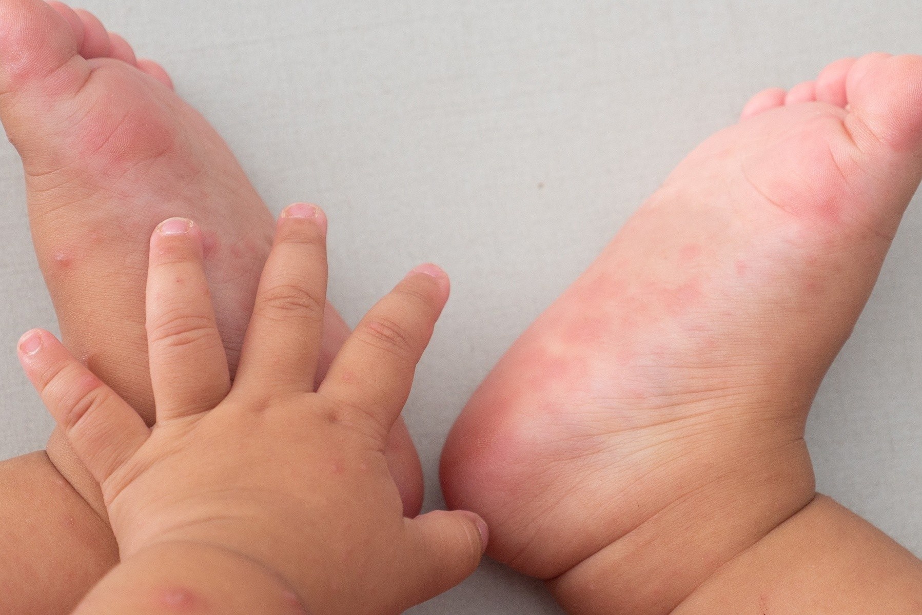 Dau hieu tre mac tay chan mieng can nhap vien ngay hinh anh