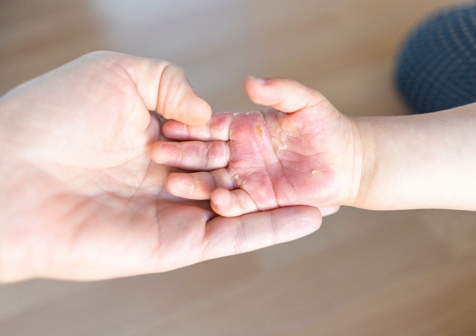 Nhung viec can lam ngay khi tre bi bong hinh anh