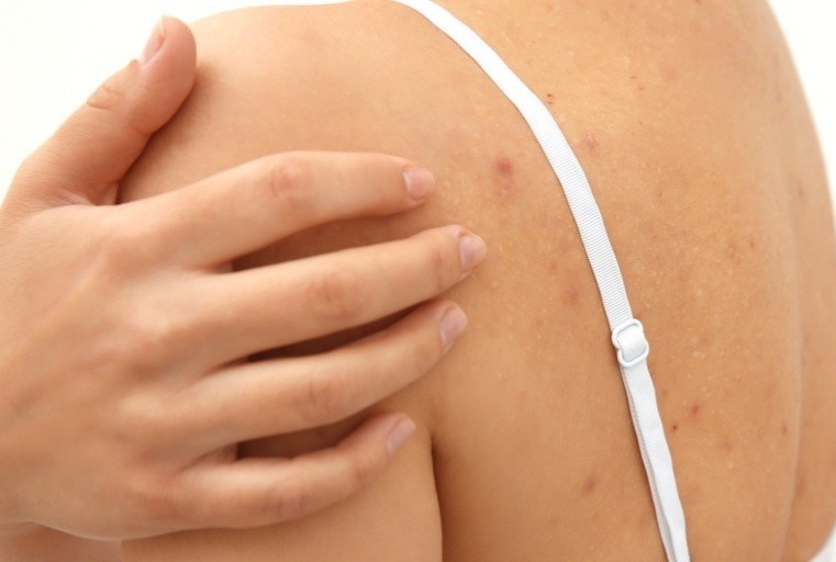 Viem nang long anh 1