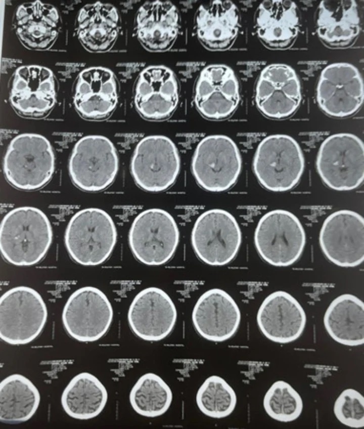 benh nhan dot quy anh 1