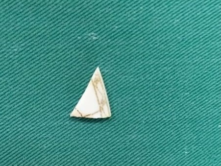 Manh sanh sac nhon bi 'bo quen' 2 nam trong khop goi be 9 tuoi hinh anh