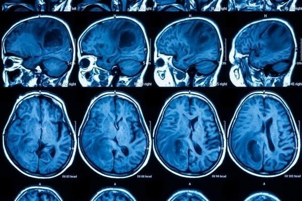 Trien vong moi cho phuong phap dieu tri ung thu nao hinh anh