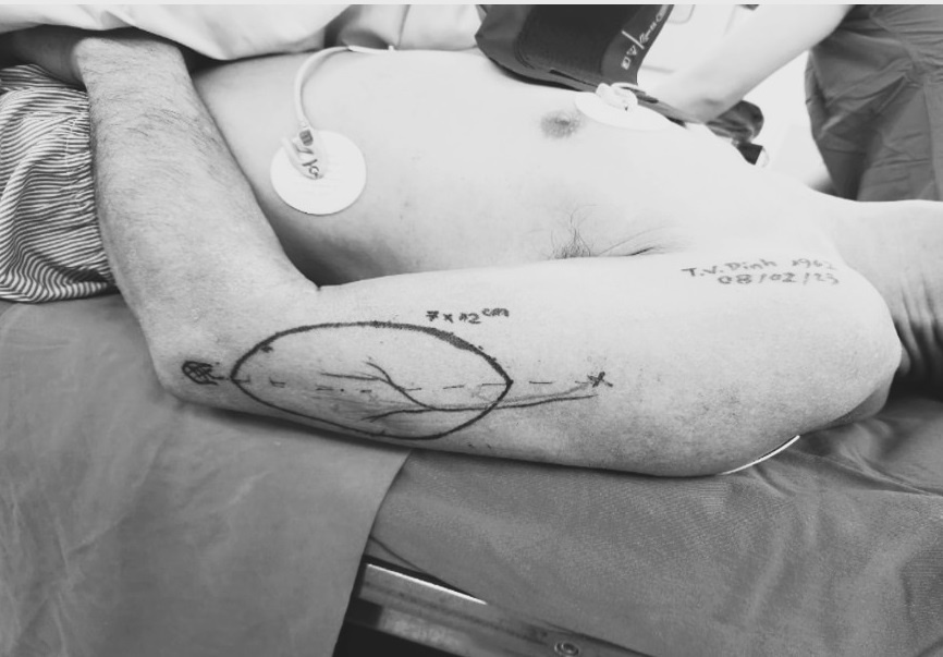 Tao hinh luoi cho nguoi dan ong bang da canh tay hinh anh