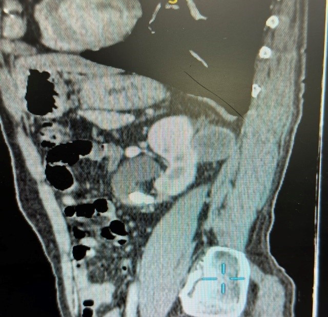 benh ung thu than anh 1