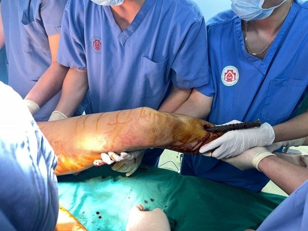 Thanh nien bi tai nan 3 coc sat dam xuyen nguoi hinh anh