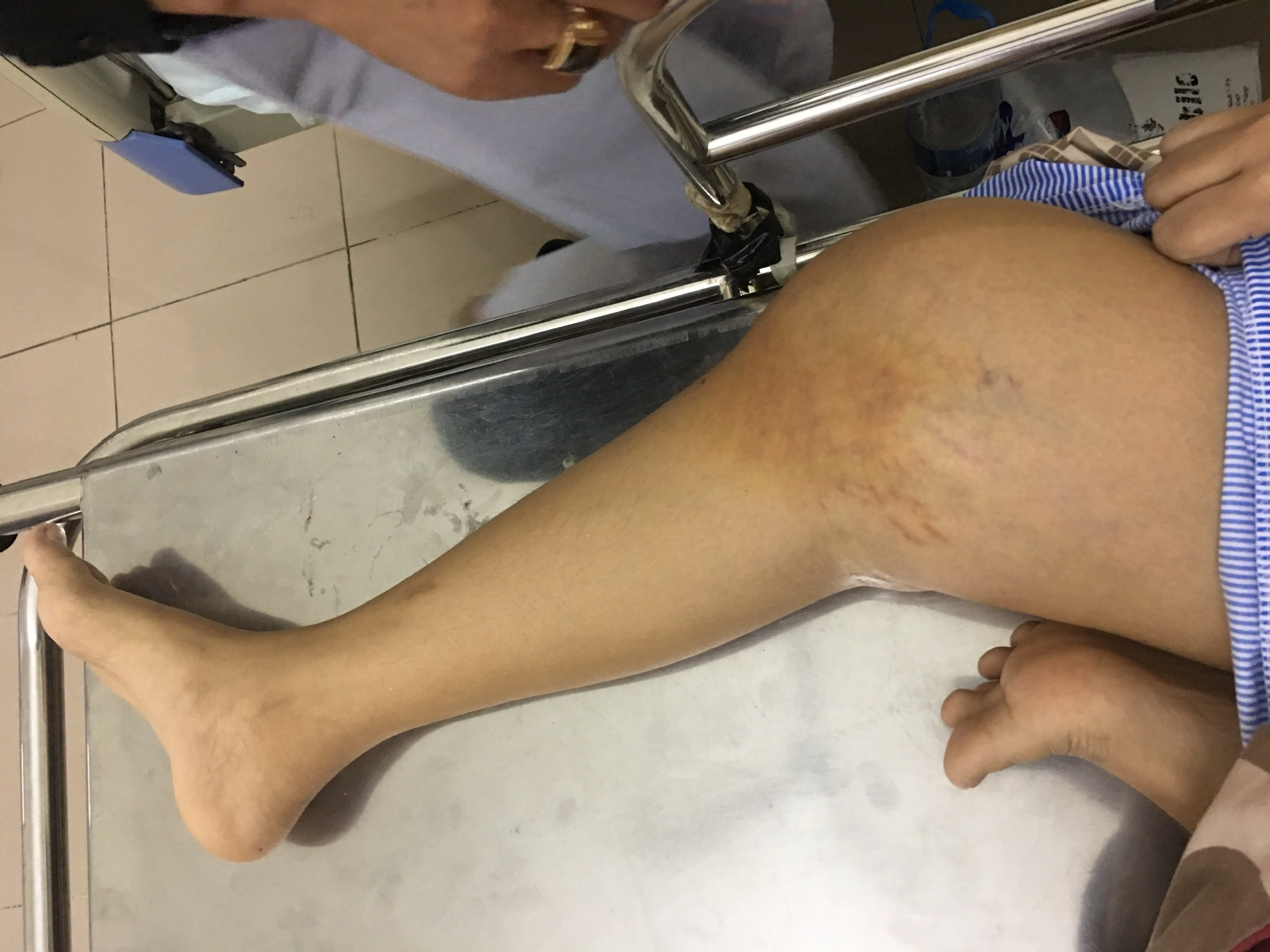 19 tuoi ung thu xuong anh 1