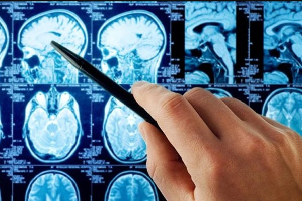 Trieu chung ung thu bi nham voi bieu hien uong qua nhieu ca phe hinh anh