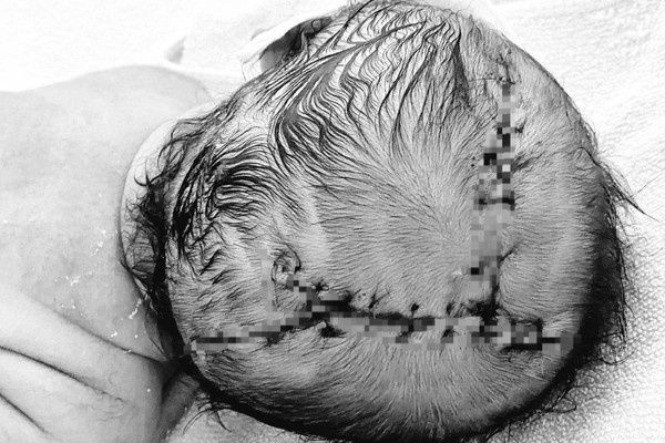 Be so sinh phai khau 21 mui tren dau vi sai lam cua nguoi nha hinh anh