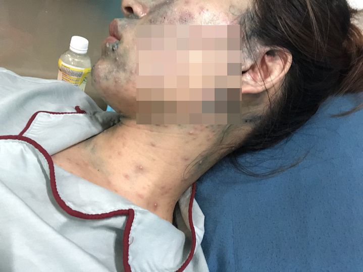 Thai phu 22 tuan phai nhap vien do mac thuy dau boi nhiem hinh anh