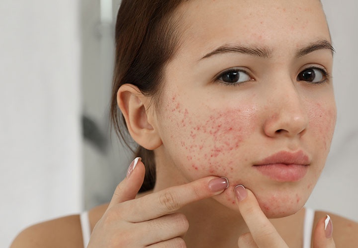 Nguyen nhan khien da mun mai khong khoi hinh anh