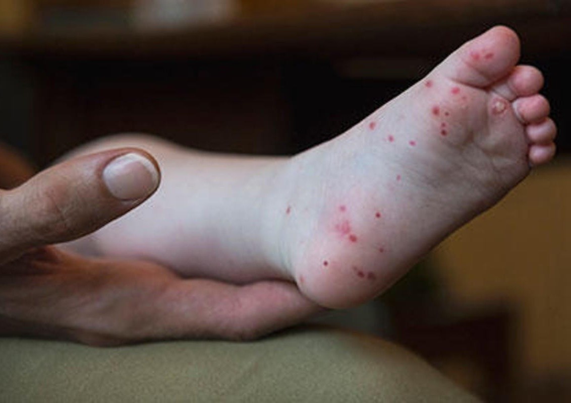 Tre bi tay chan mieng nen kieng va an gi? hinh anh