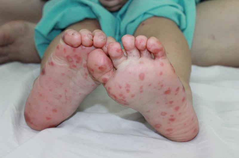 benh tay chan mieng anh 1