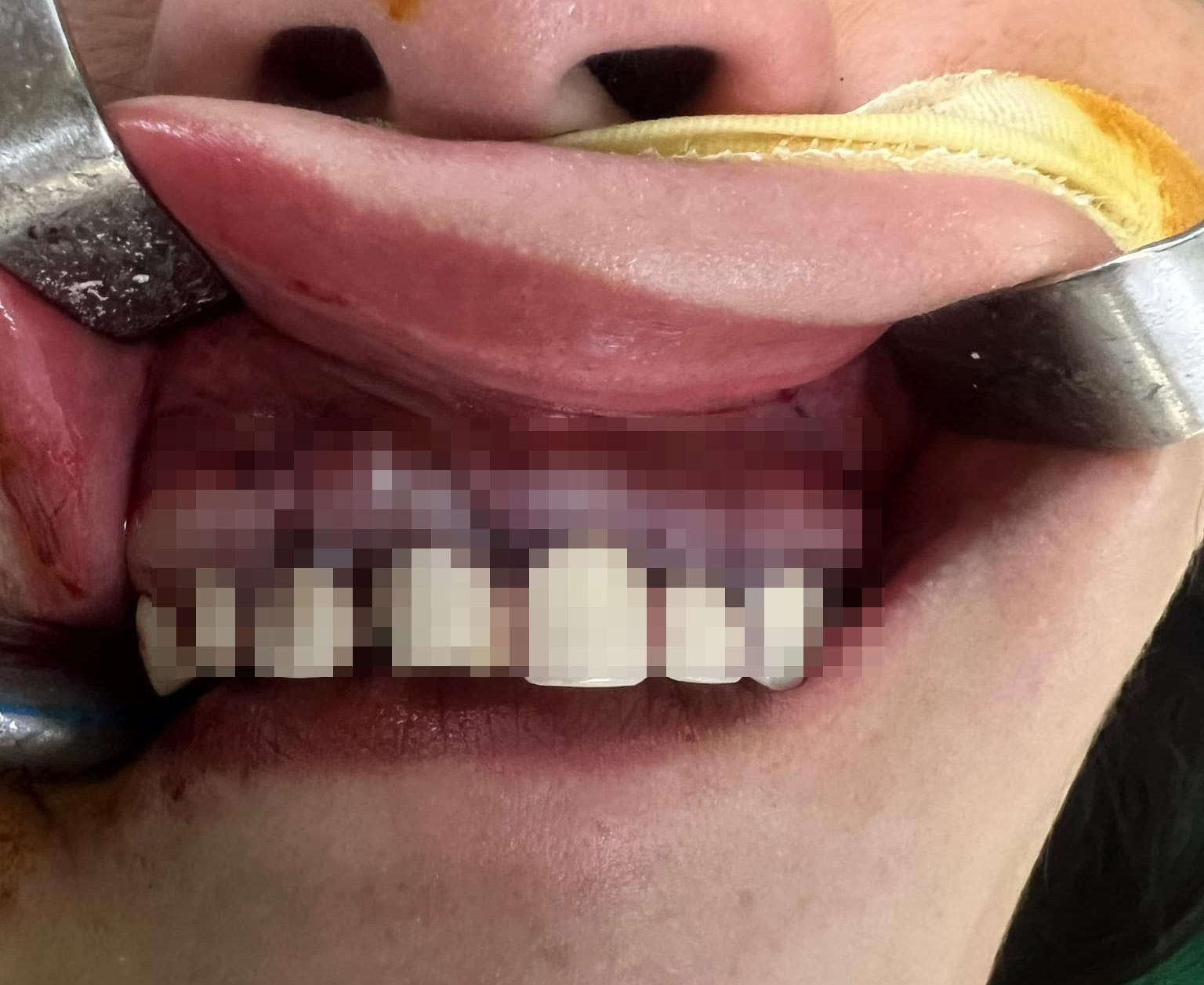 boc rang tham my anh 1