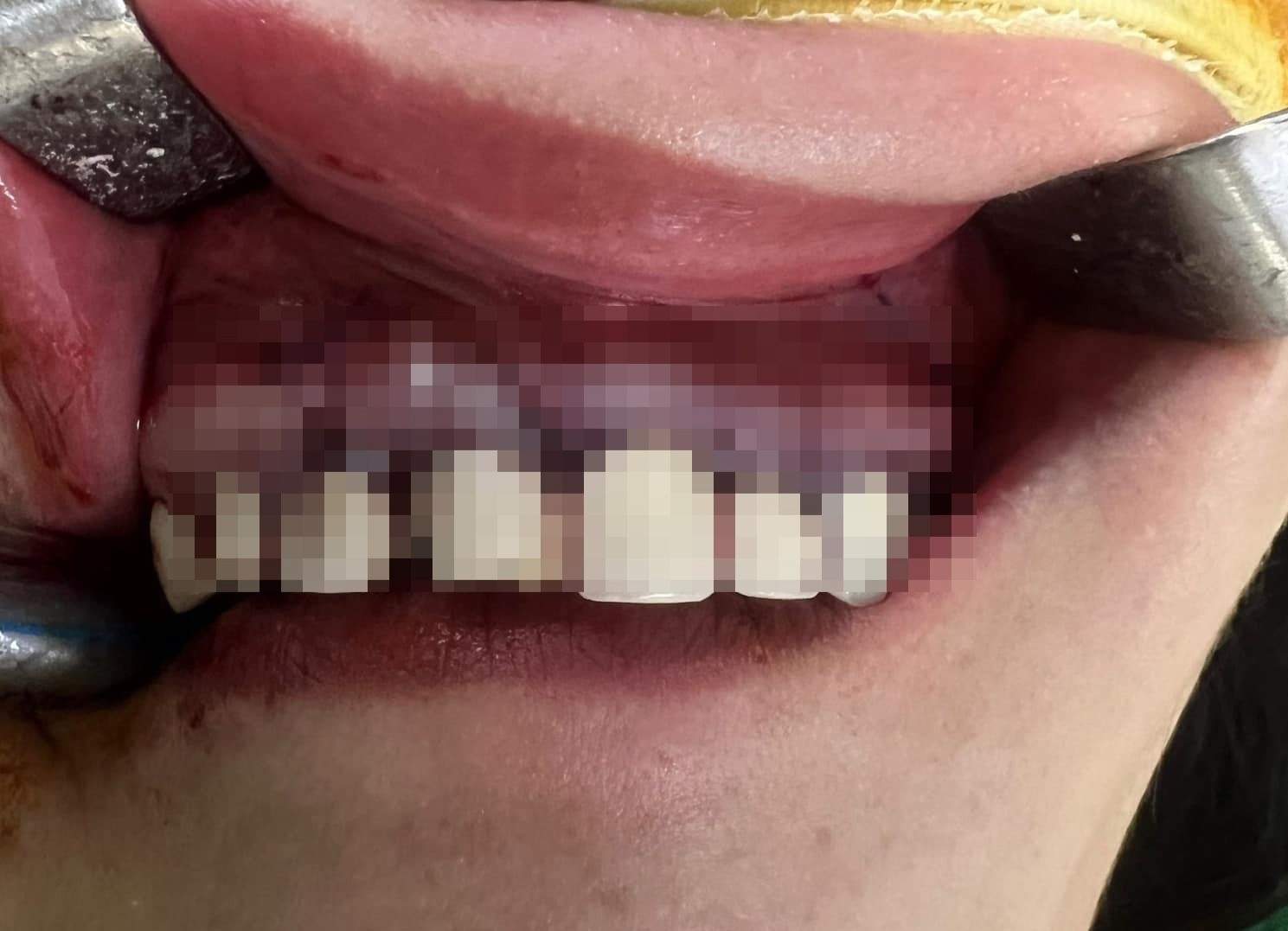 Nguoi phu nu 36 tuoi phai phau thuat do boc rang tham my hinh anh