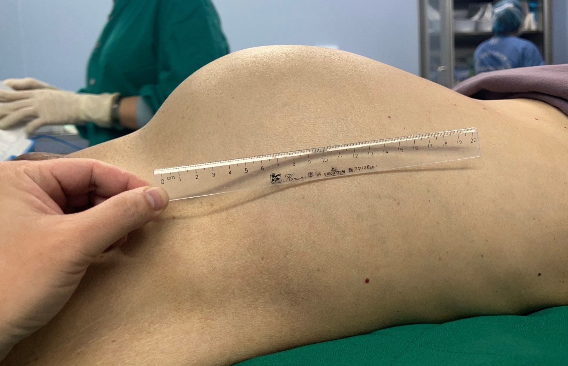Benh hiem khien khoi u lon bat thuong, nang 5,5 kg chi sau 5 thang hinh anh