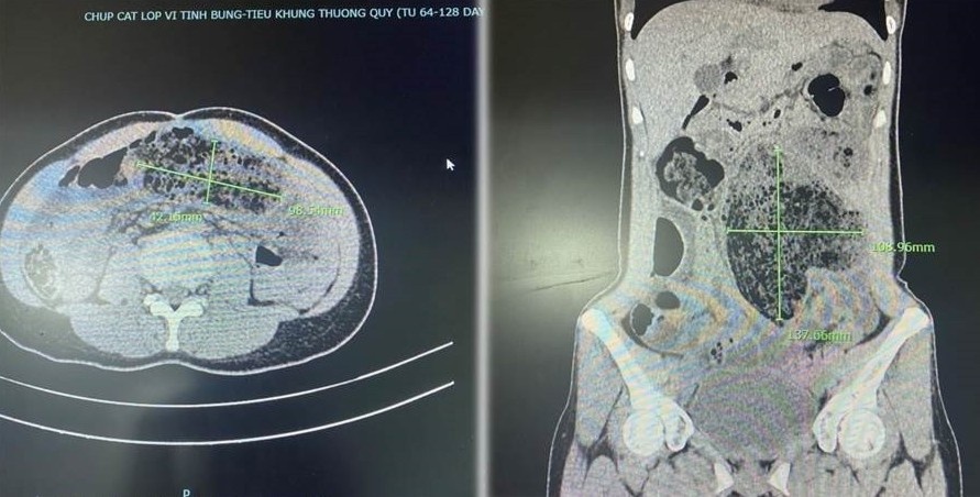 an qua nhieu mit anh 1