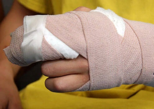 Nguoi dan ong nhap vien voi ban tay dap nat do may cua nghien hinh anh