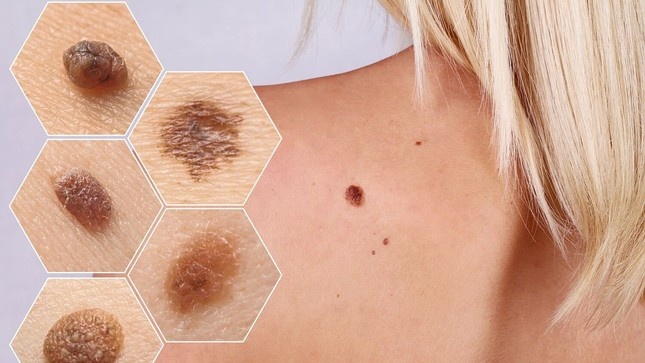 Not ruoi ung thu anh 2