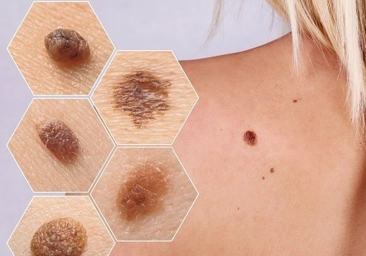 Not ruoi co dau hieu nay nen di kham ung thu hinh anh