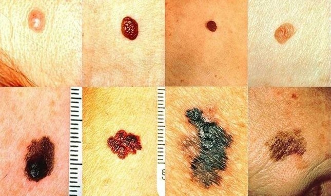 Not ruoi ung thu anh 1