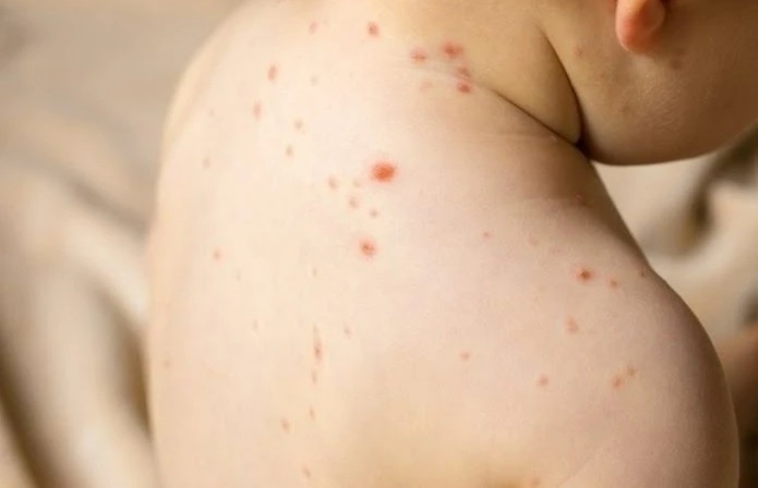 Dich soi phuc tap tai nhieu quoc gia, Bo Y te phat canh bao hinh anh