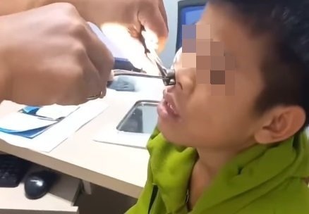 Gap ky sinh trung dai 8 cm trong mui thieu nien hinh anh