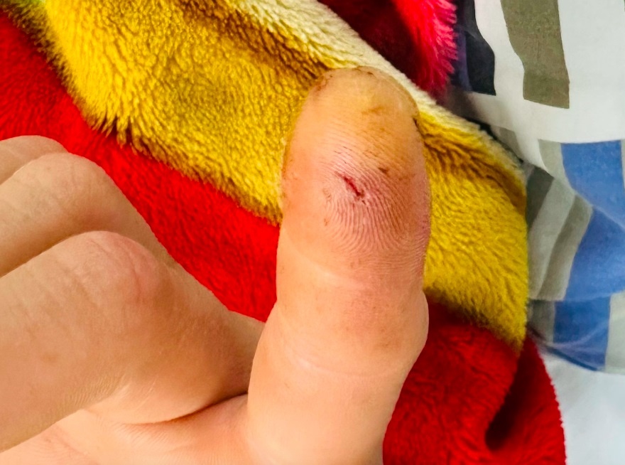 Nhap vien sau khi bi loai vat long vang, ve ngoai hien lanh can hinh anh