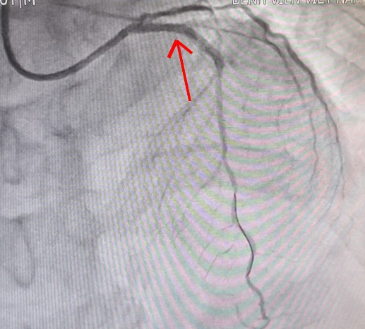 nhoi mau co tim anh 2